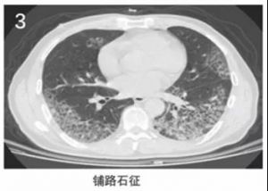 新冠肺炎铺路石征