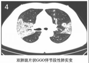 双肺斑片状GGO伴节段性肺实变