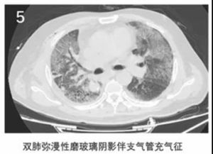 双肺弥漫性磨玻璃阴影伴支气管充气征