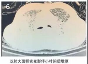 双肺大面积实变影伴小叶间质增厚
