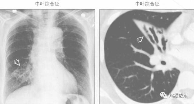 【书摘】“右肺中叶综合征”的鉴别诊断