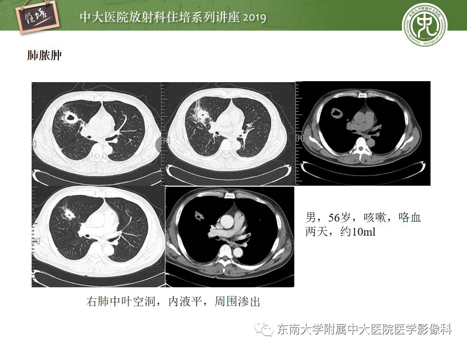 【PPT】咯血的临床及影像分析思路