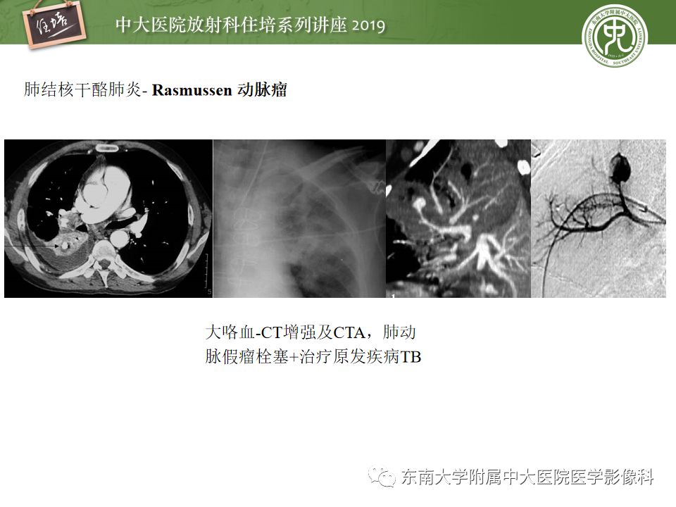 【PPT】咯血的临床及影像分析思路
