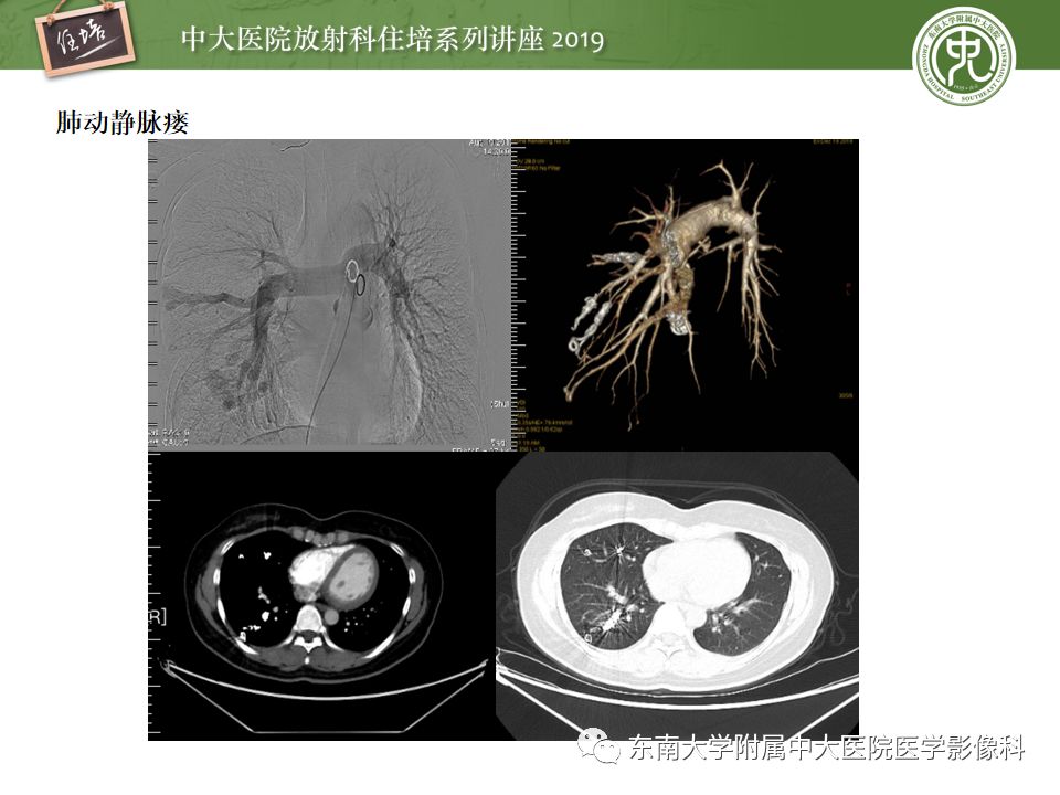 【PPT】咯血的临床及影像分析思路