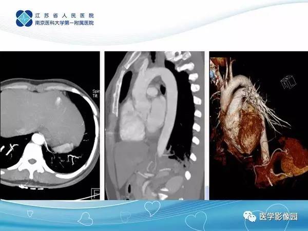 【PPT】肺隔离症5例CT影像诊断与鉴别