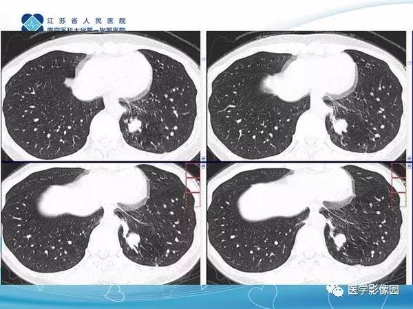 【PPT】肺隔离症5例CT影像诊断与鉴别