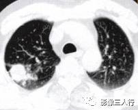 “毛刺征” 的影像表现与临床意义 “毛刺征” 的影像表现与临床意义