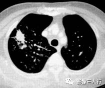 “毛刺征” 的影像表现与临床意义