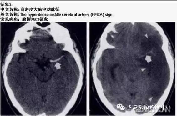 典型影像征象收集 典型影像征象收集