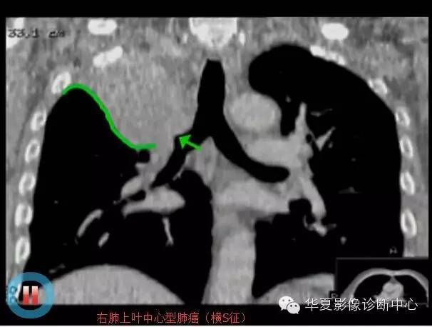 典型影像征象收集