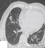 “空泡征” 的影像表现与临床意义