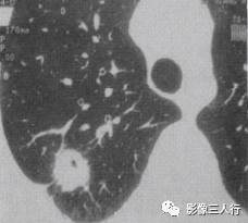 “空泡征” 的影像表现与临床意义