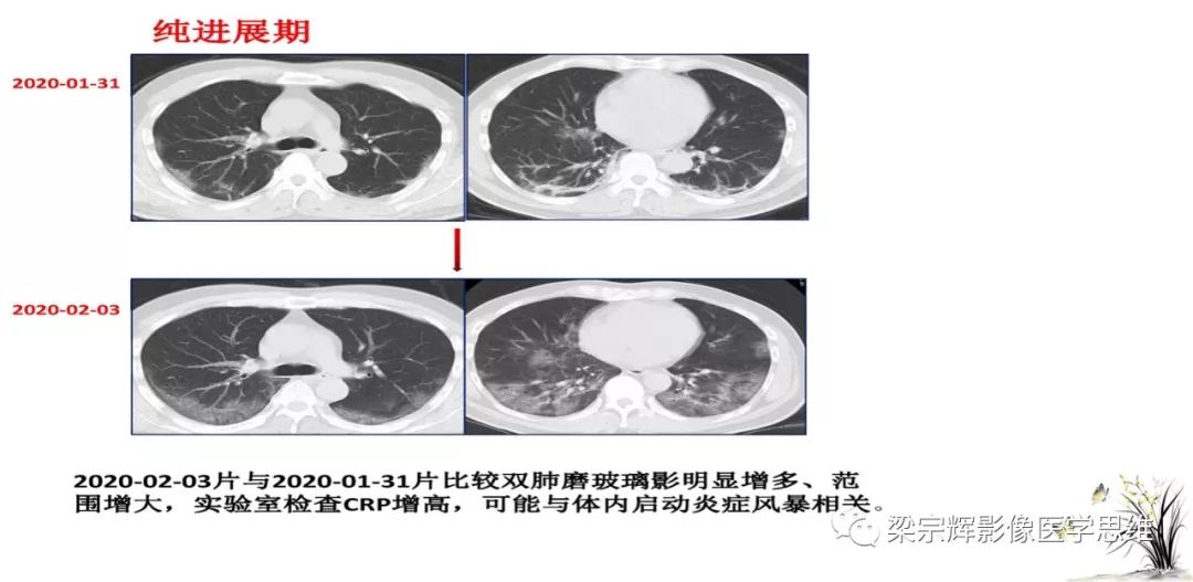 【PPT】山西新型冠状病毒肺炎影像学表现初探