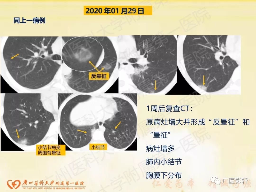 【PPT】新型冠状病毒肺炎影像学特点 【PPT】新型冠状病毒肺炎影像学特点