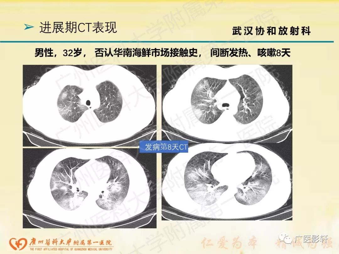 【PPT】新型冠状病毒肺炎影像学特点 【PPT】新型冠状病毒肺炎影像学特点