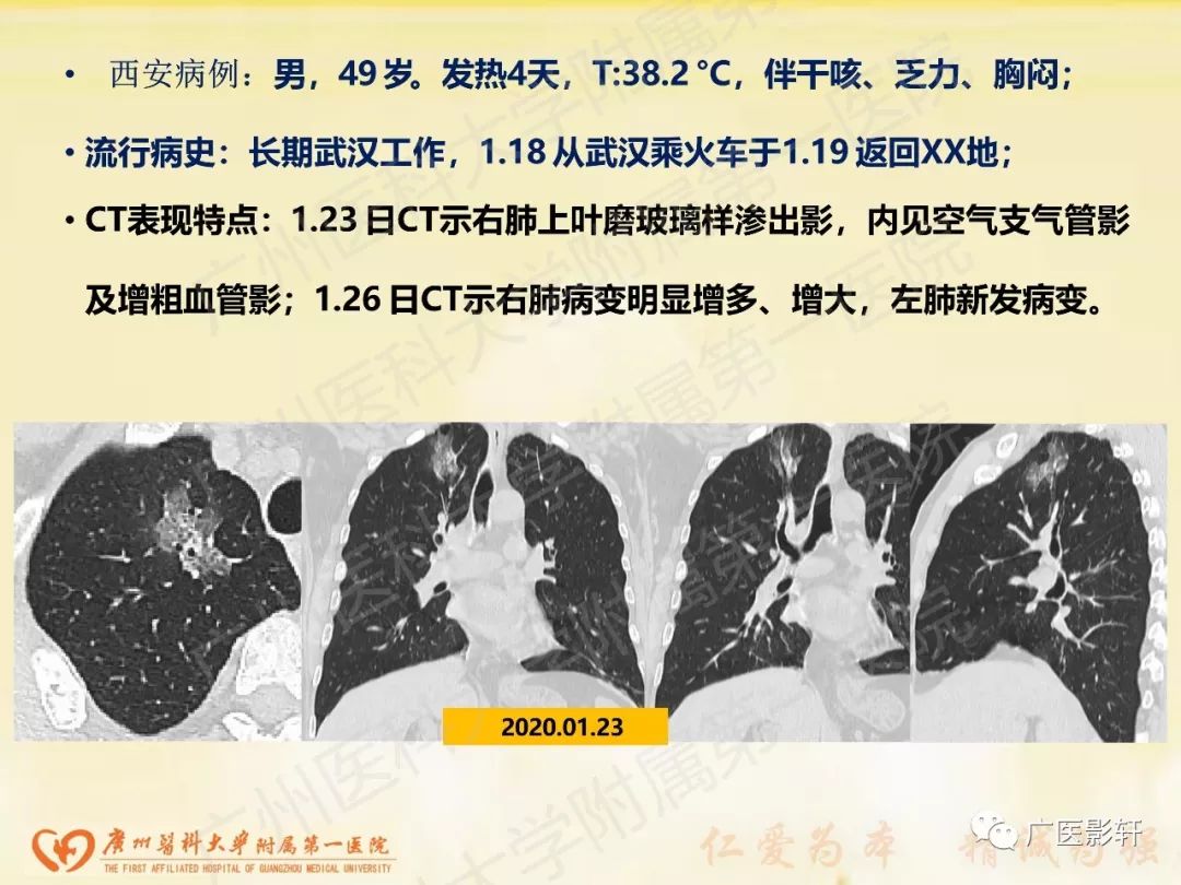 【PPT】新型冠状病毒肺炎影像学特点 【PPT】新型冠状病毒肺炎影像学特点