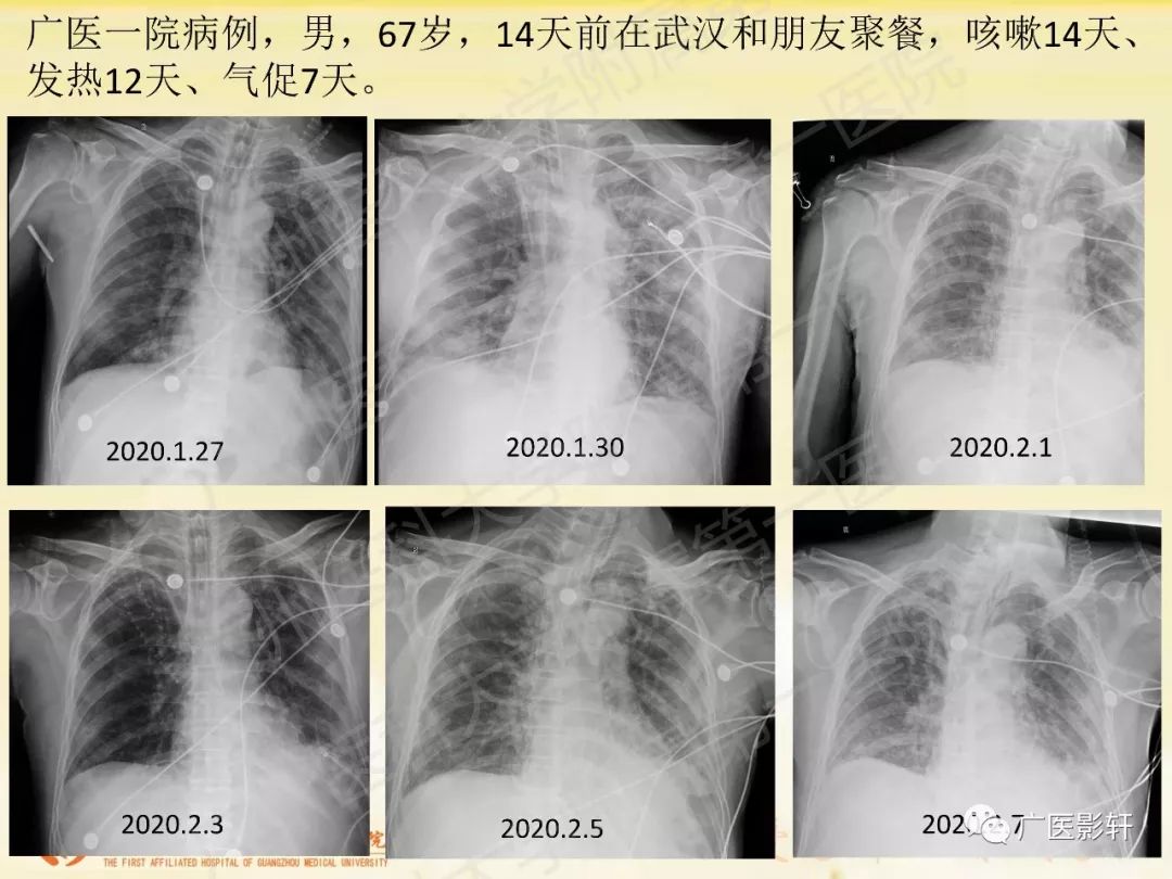 【PPT】新型冠状病毒肺炎影像学特点 【PPT】新型冠状病毒肺炎影像学特点