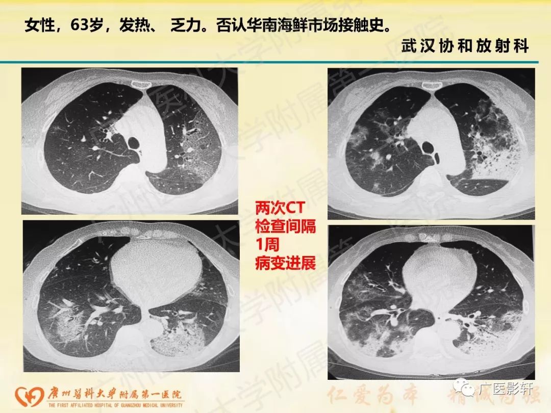 【PPT】新型冠状病毒肺炎影像学特点 【PPT】新型冠状病毒肺炎影像学特点