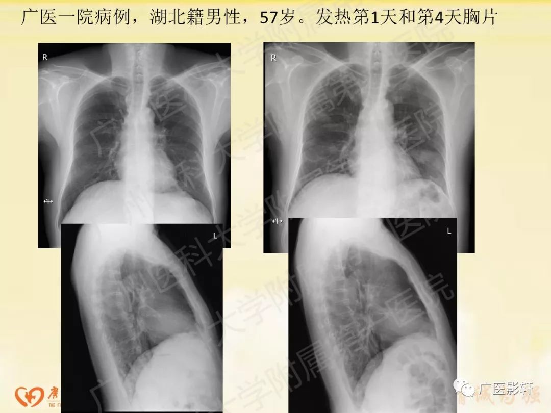 【PPT】新型冠状病毒肺炎影像学特点 【PPT】新型冠状病毒肺炎影像学特点
