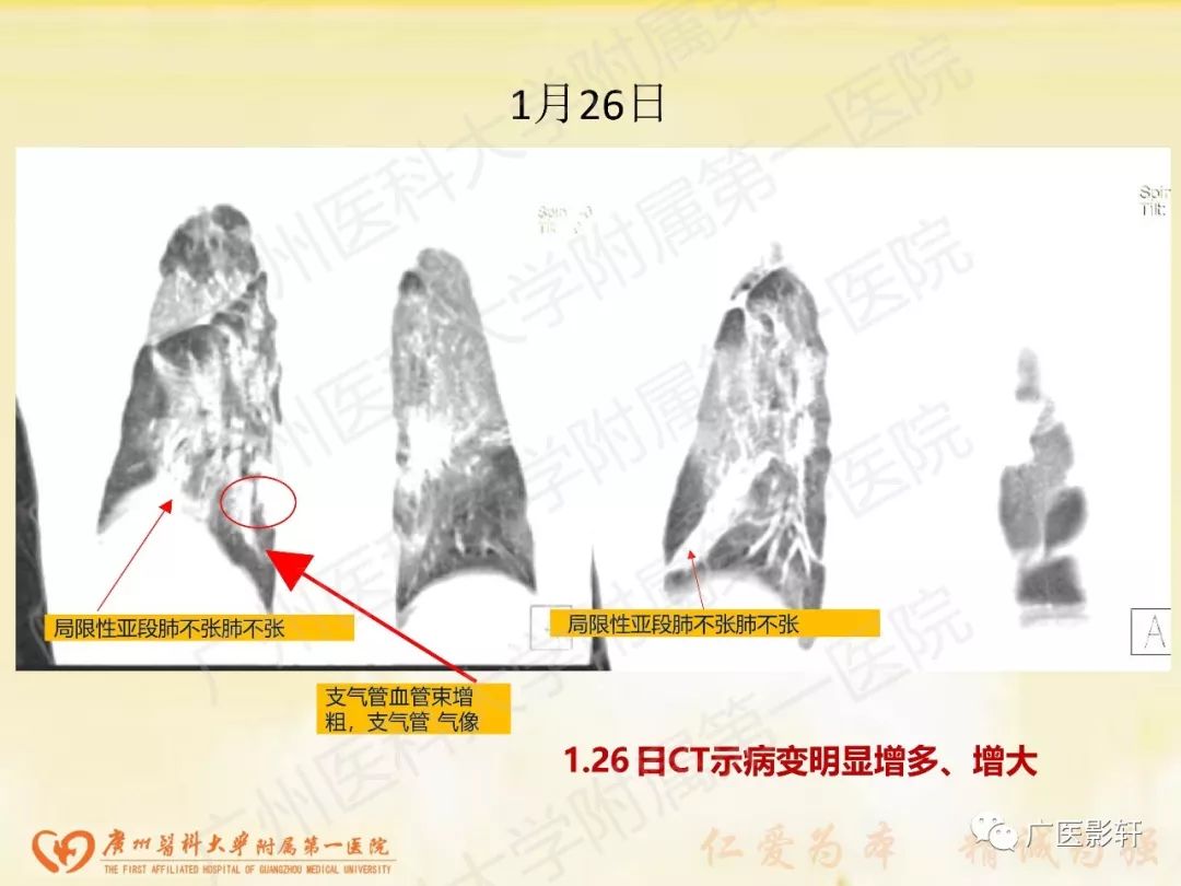 【PPT】新型冠状病毒肺炎影像学特点 【PPT】新型冠状病毒肺炎影像学特点