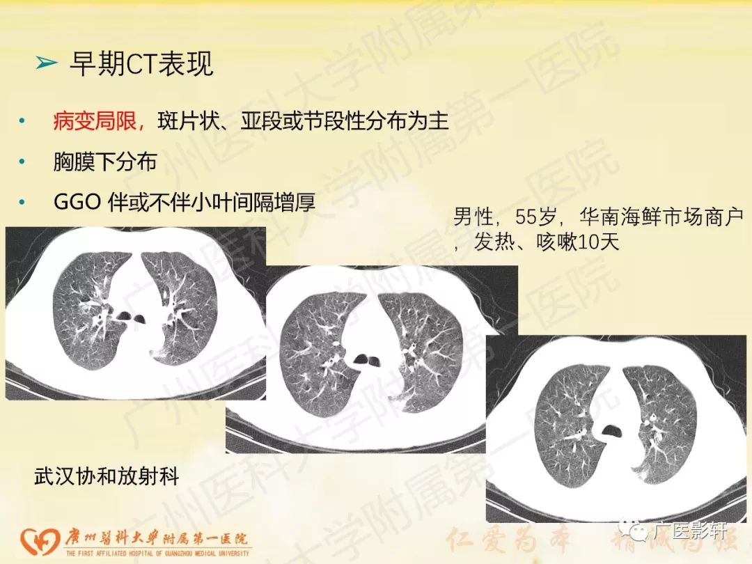 【PPT】新型冠状病毒肺炎影像学特点 【PPT】新型冠状病毒肺炎影像学特点