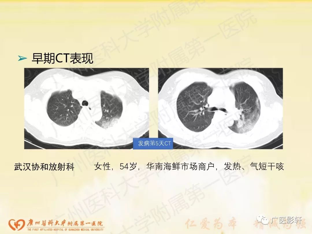 【PPT】新型冠状病毒肺炎影像学特点 【PPT】新型冠状病毒肺炎影像学特点