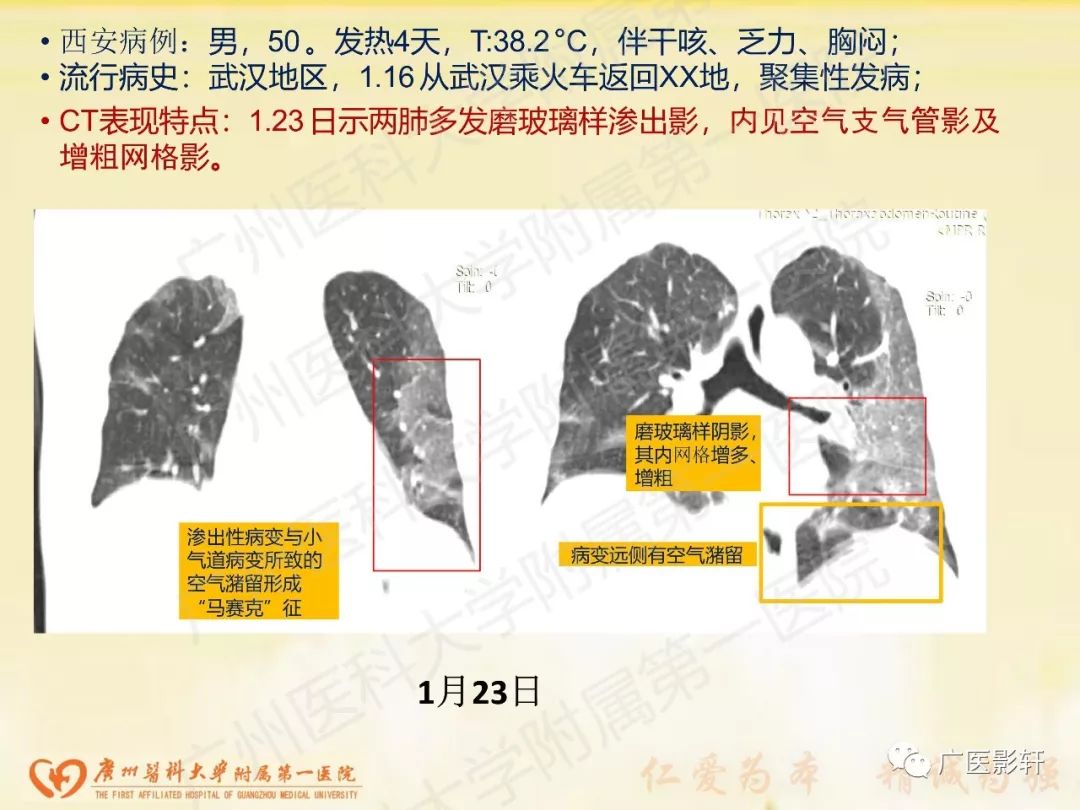 【PPT】新型冠状病毒肺炎影像学特点 【PPT】新型冠状病毒肺炎影像学特点