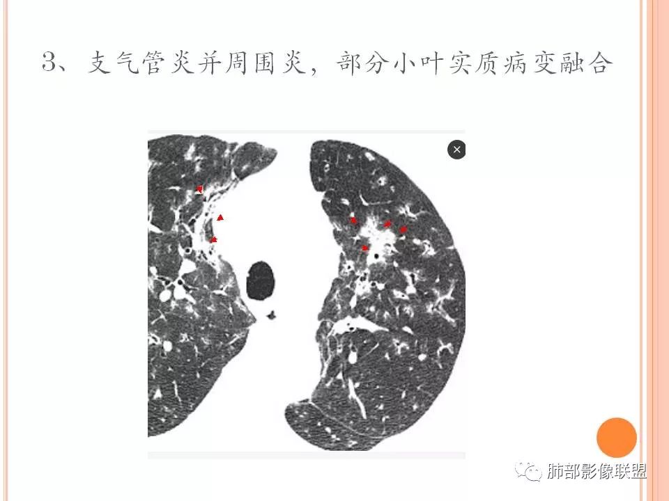 【PPT】支原体肺炎影像分析