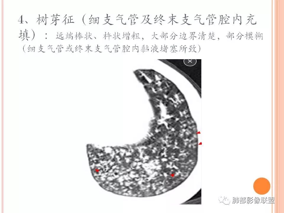 【PPT】支原体肺炎影像分析