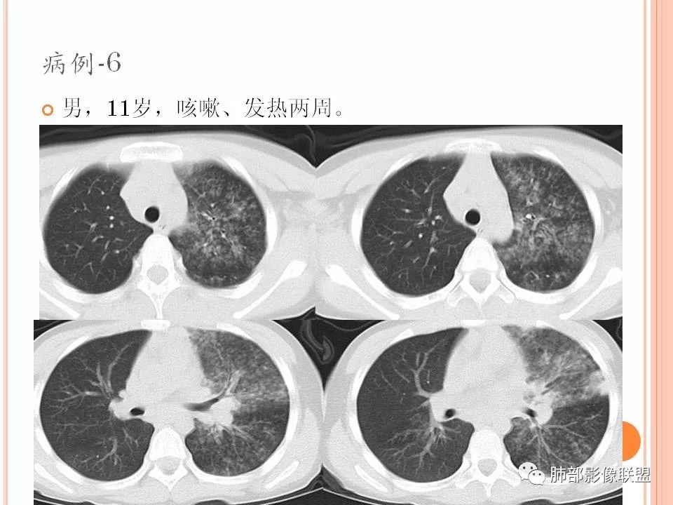 【PPT】支原体肺炎影像分析