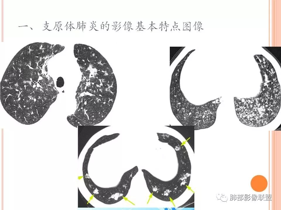 【PPT】支原体肺炎影像分析