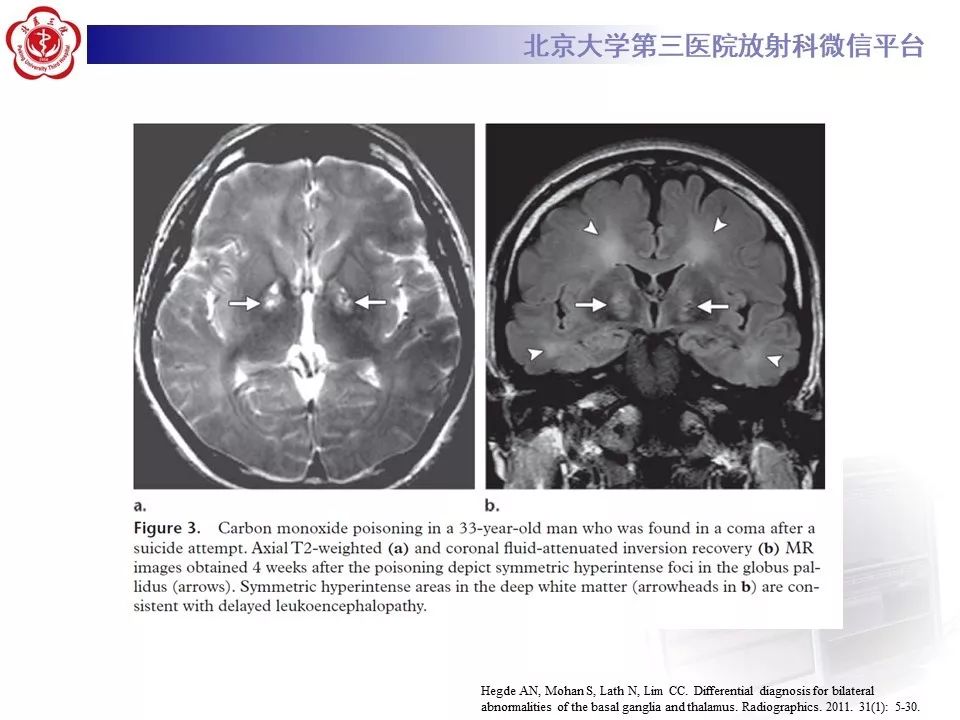 【PPT】中毒性脑病的影像