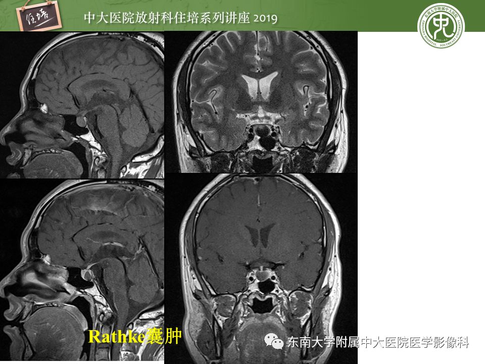 【PPT】垂体正常及常见疾病影像表现