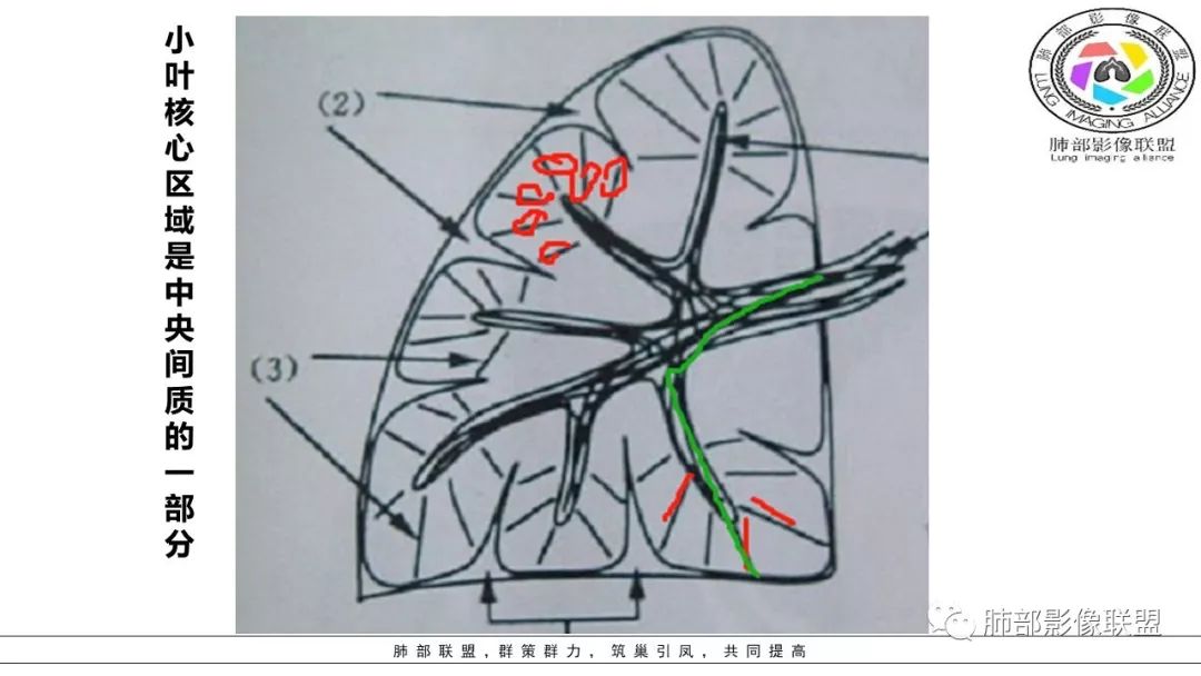 【PPT】病毒肺炎影像机制探讨