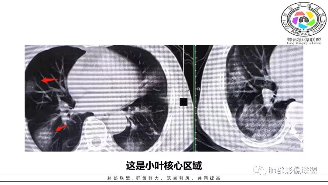 【PPT】病毒肺炎影像机制探讨