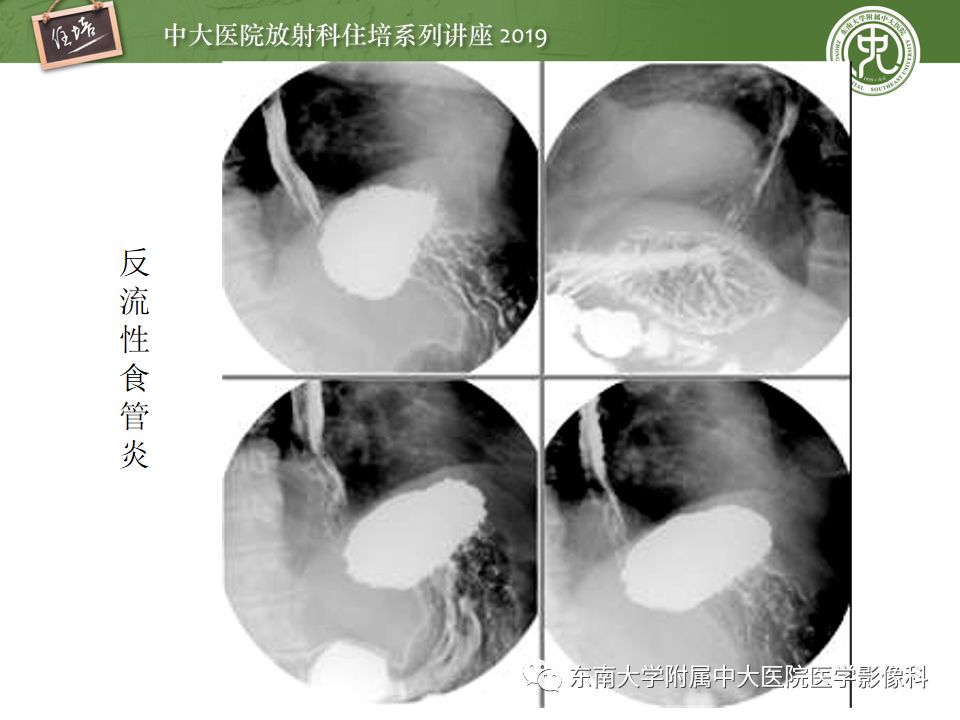 【PPT】食管常见疾病的诊断和鉴别诊断