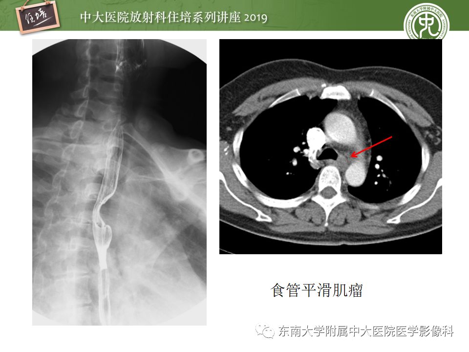 【PPT】食管常见疾病的诊断和鉴别诊断
