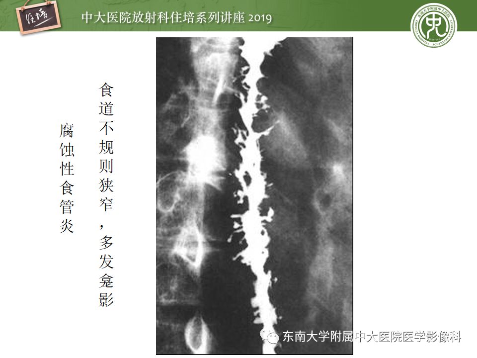【PPT】食管常见疾病的诊断和鉴别诊断