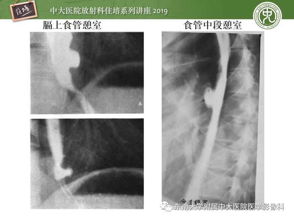【PPT】食管常见疾病的诊断和鉴别诊断