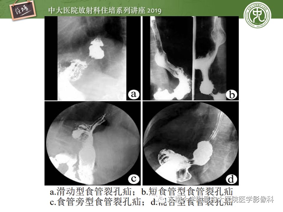 【PPT】食管常见疾病的诊断和鉴别诊断