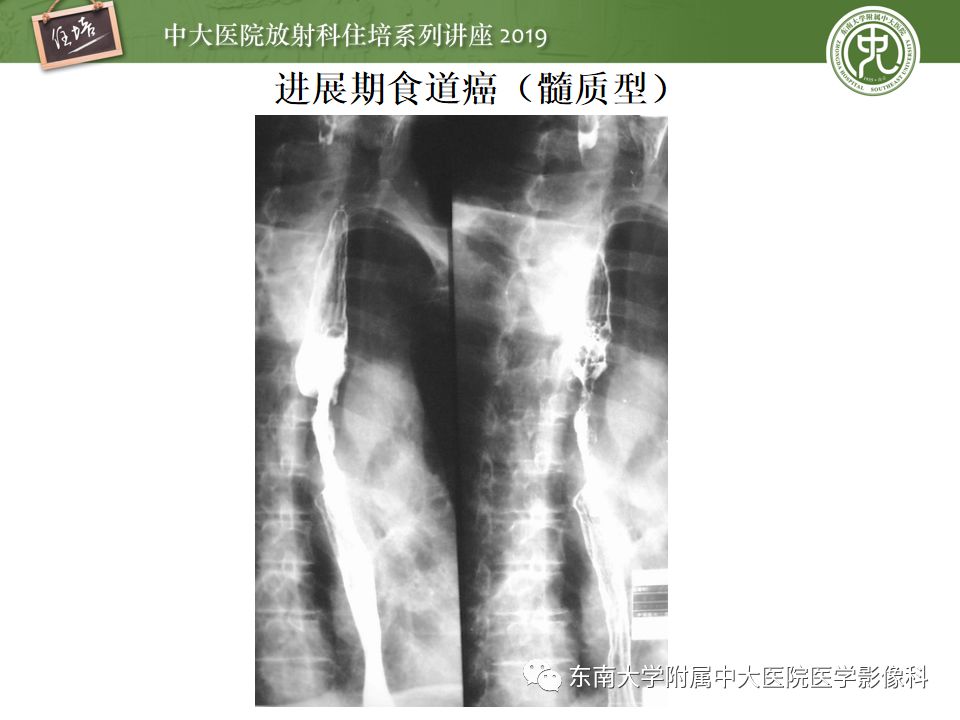 【PPT】食管常见疾病的诊断和鉴别诊断