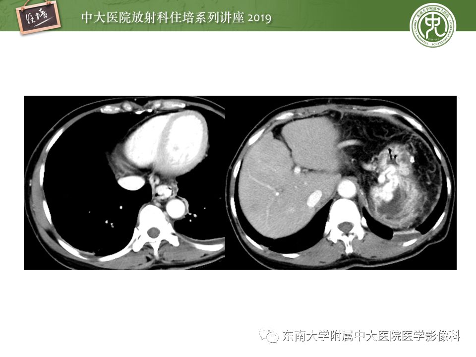【PPT】食管常见疾病的诊断和鉴别诊断