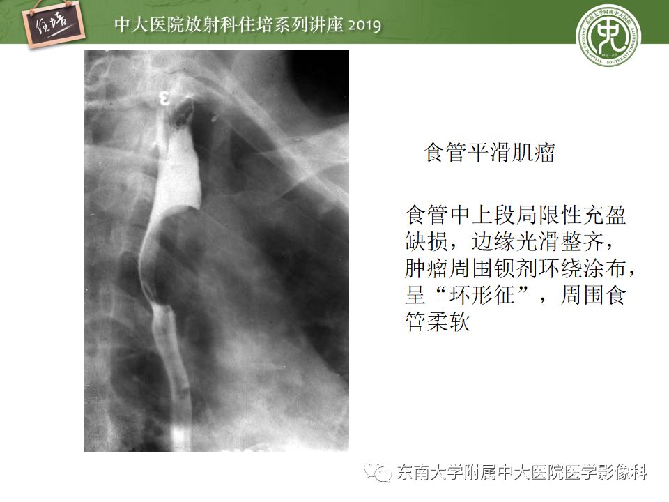 【PPT】食管常见疾病的诊断和鉴别诊断