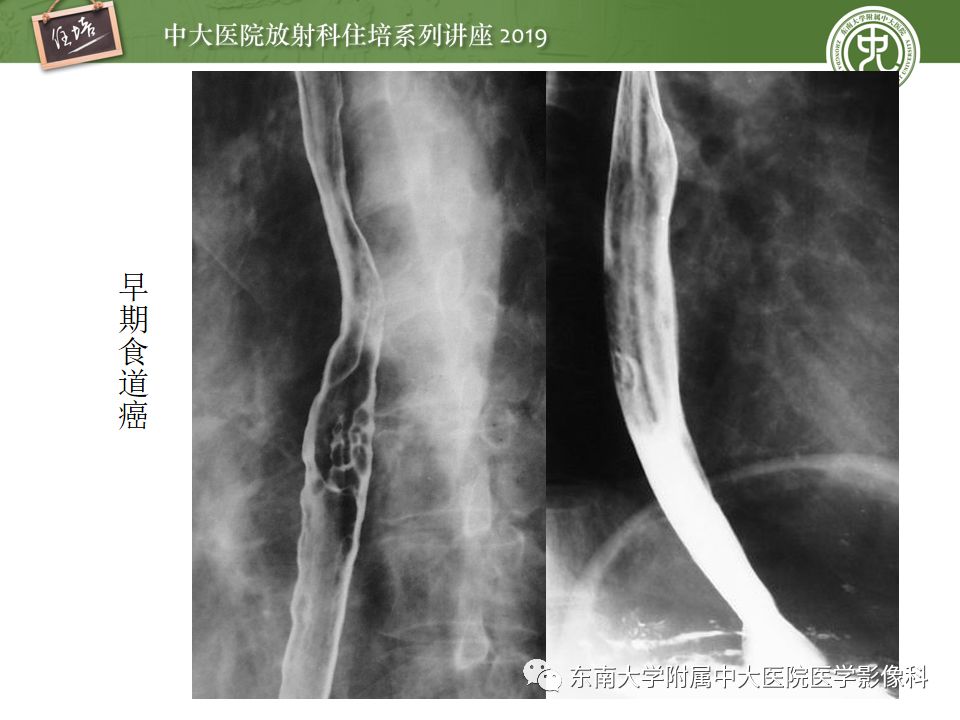 【PPT】食管常见疾病的诊断和鉴别诊断