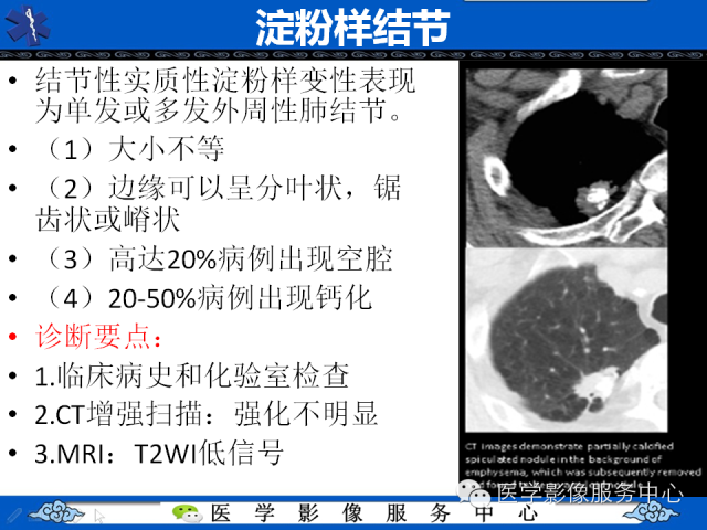 【PPT】肺癌的影像学鉴别诊断实例：哪些不是肺癌