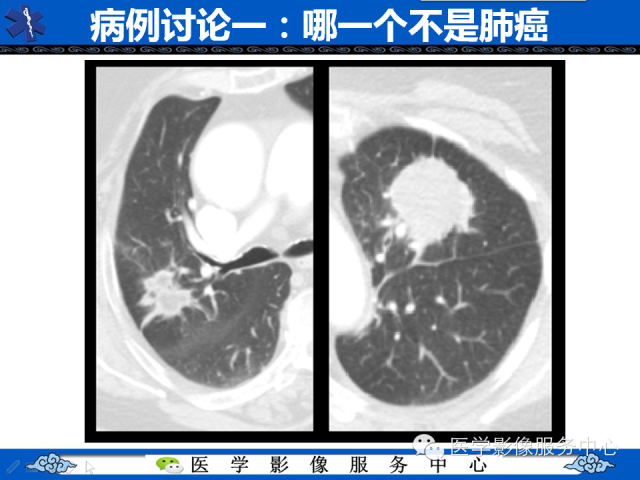 【PPT】肺癌的影像学鉴别诊断实例：哪些不是肺癌