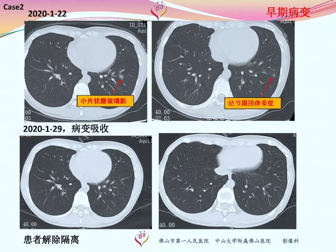 【PPT】CT室对新型冠状病毒肺炎的应对策略及影像诊断分析