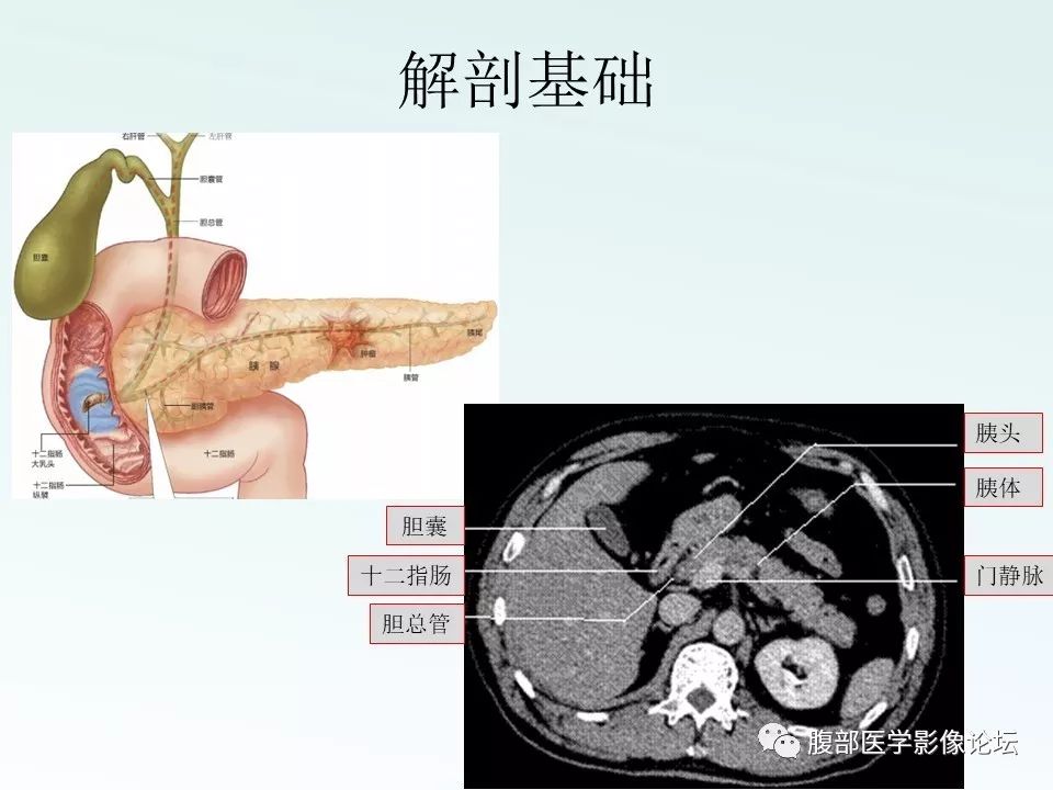 【PPT】沟槽性胰腺炎