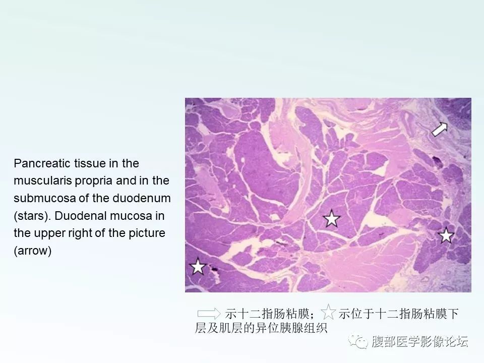 【PPT】沟槽性胰腺炎