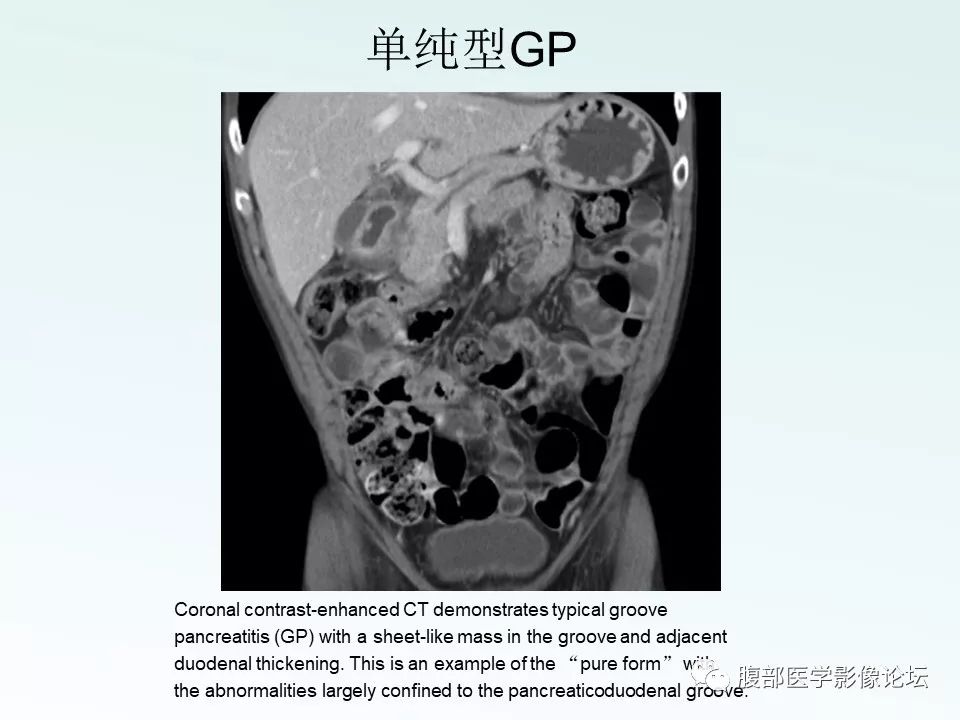 【PPT】沟槽性胰腺炎